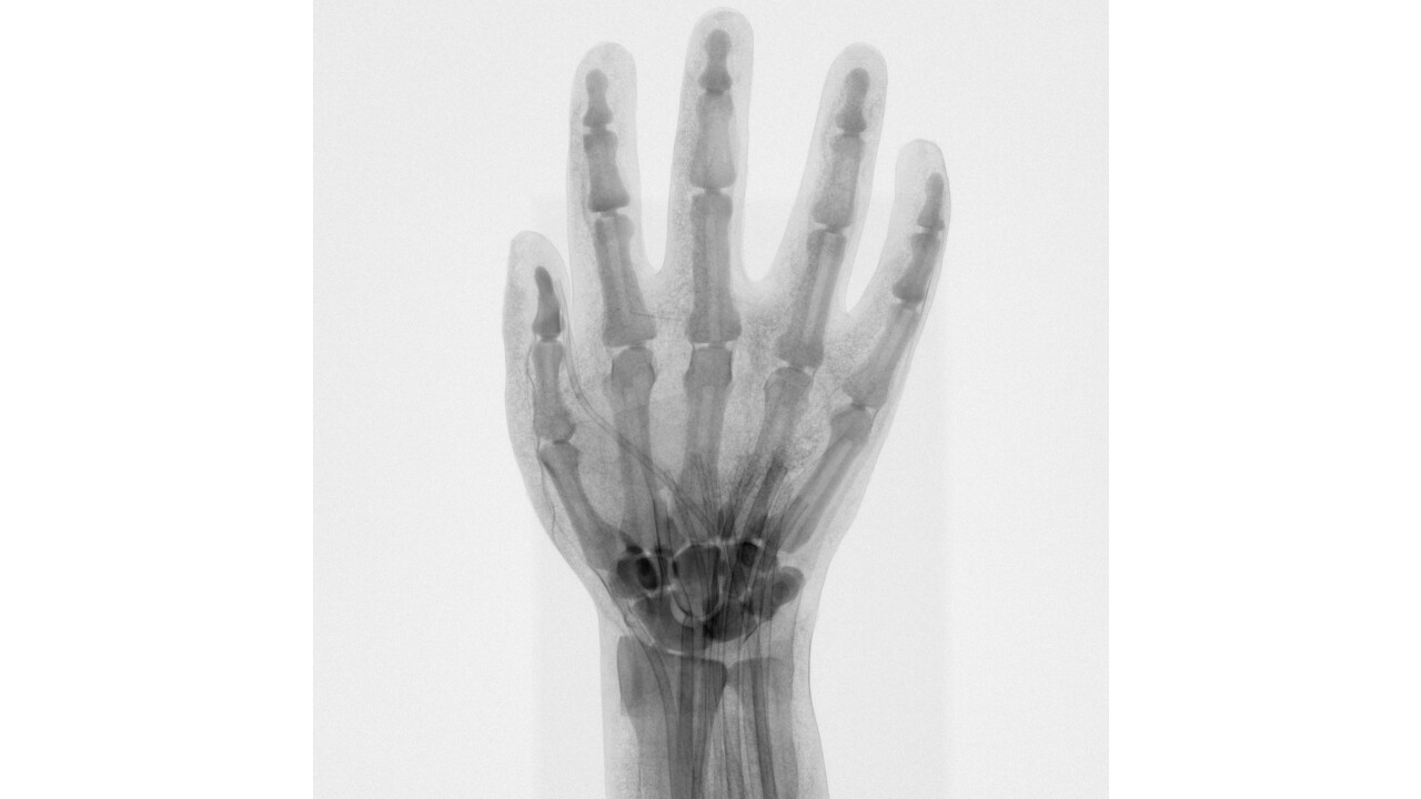CT-Bildgebung der Hand