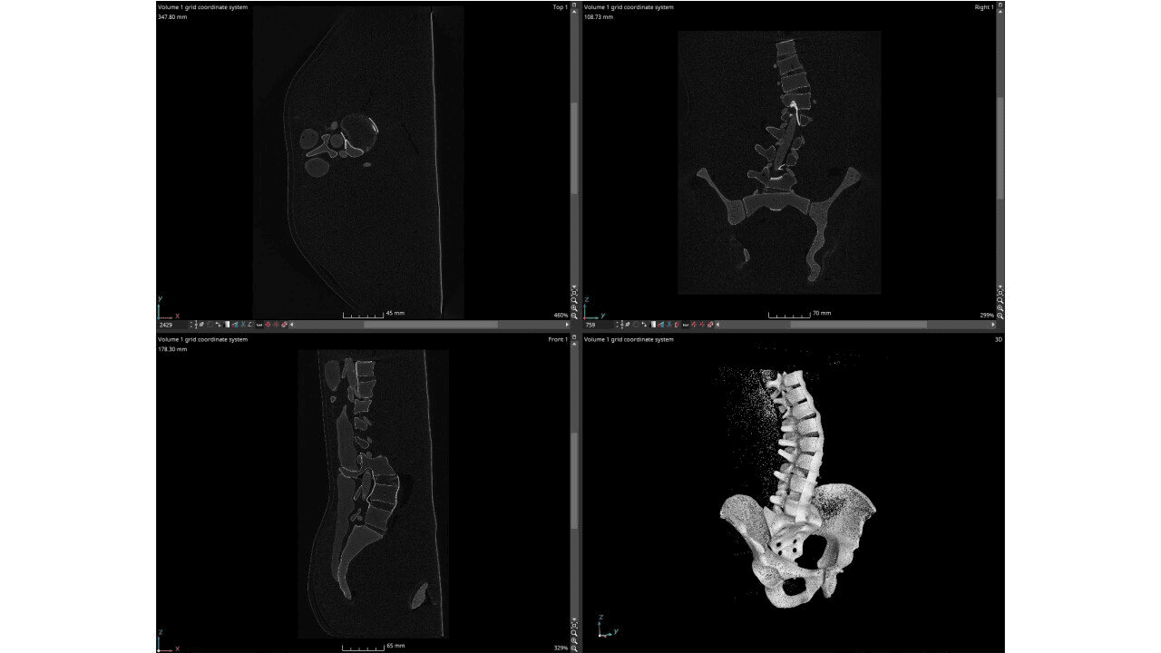 CT-Bilder des Modells mit Skoliose-Deformität